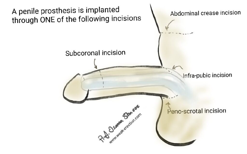 Incisions for penile implant surgery
