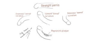 Penile curvature or penile deviation Is when the penis is not straight which may affect cosmetic outlook and sexual intercourse