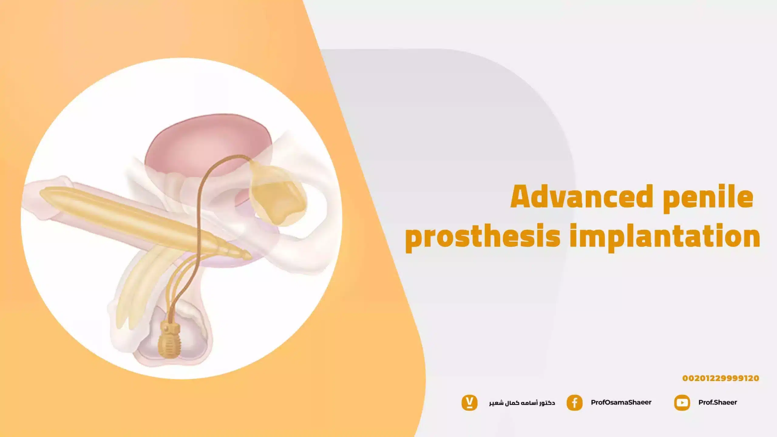 Advanced Penile Prosthesis Implantation