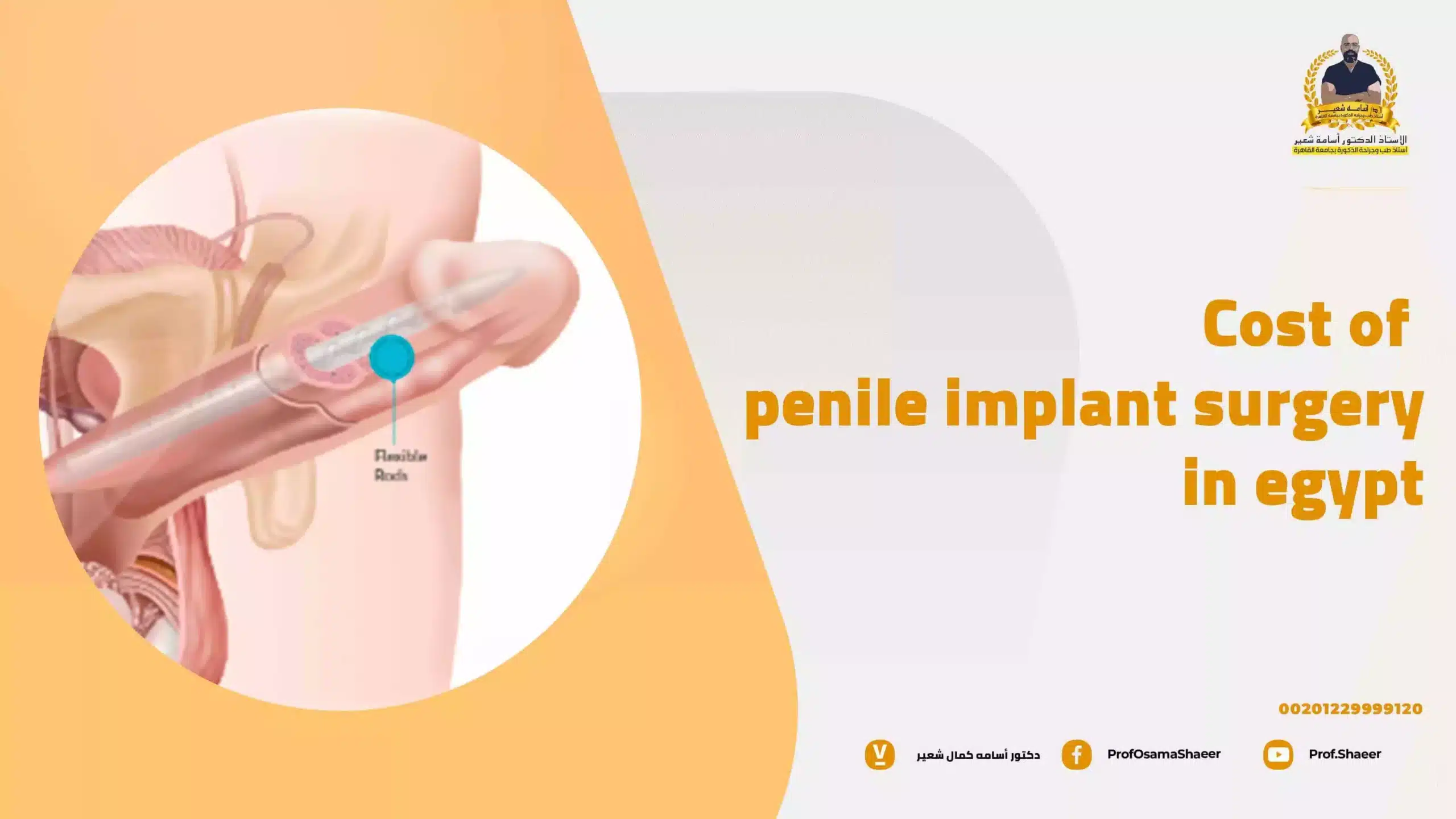 Cost of Penile Implant Surgery in Egypt