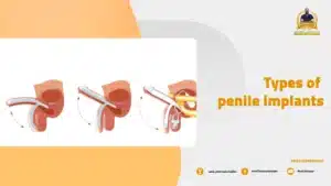 TYPES OF PENILE IMPLANTS