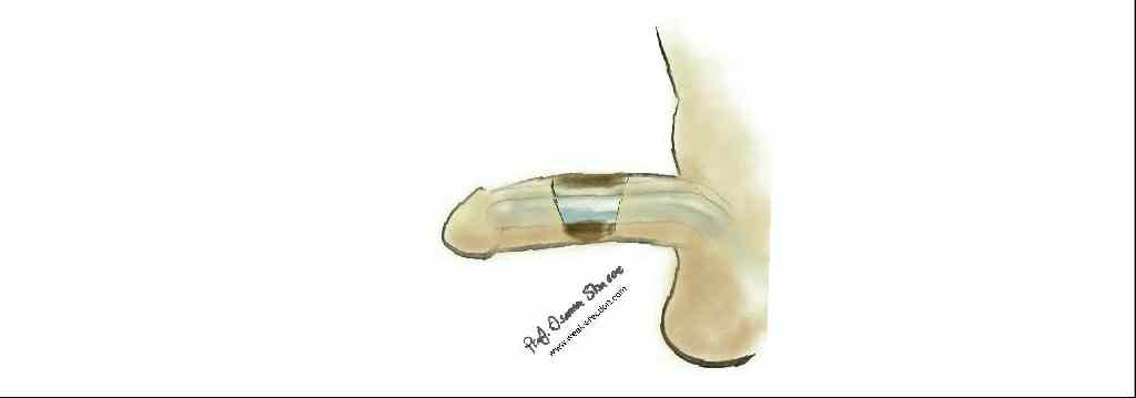 PENILNI IMPLANTAT – PENILNA PROTEZA