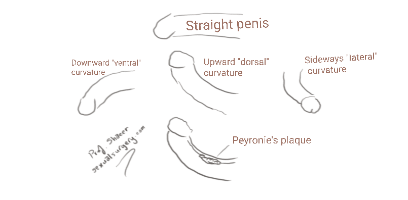 Penilna kurvatura – Devijacija penisa