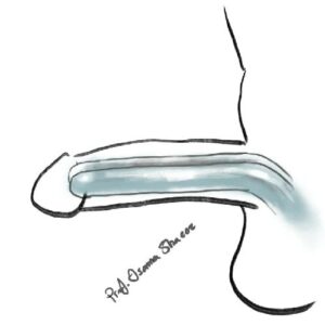 Penile implant cylinders are totally hidden inside the penis