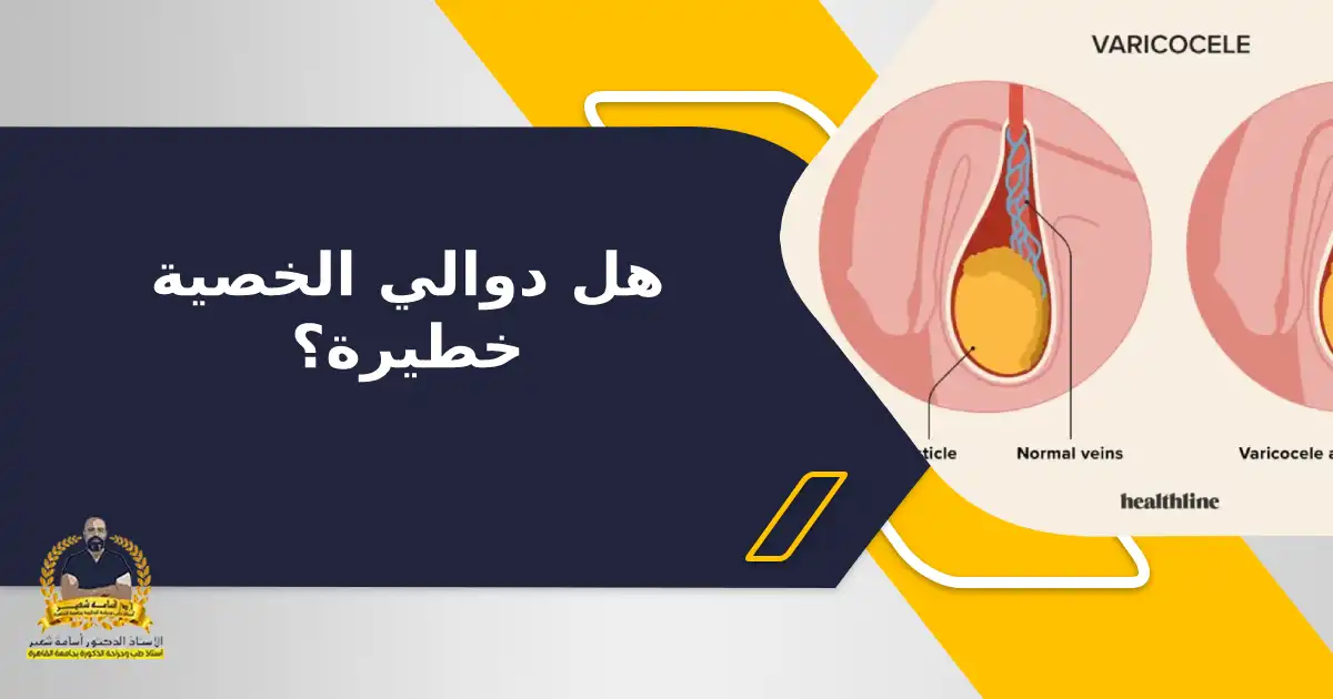 هل دوالي الخصية خطيرة