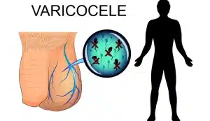 Read more about the article 5 أسباب وراء الألم بعد عملية دوالي الخصية اليسرى
