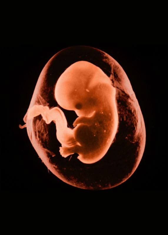 Obstructive Azoospermia