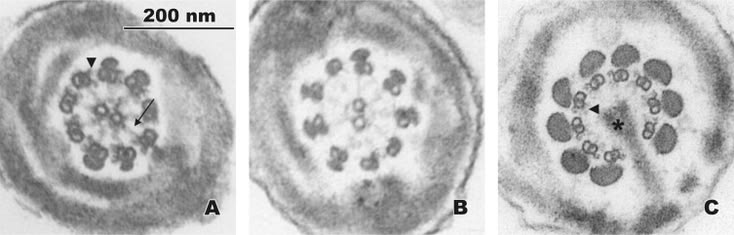 Non-Obstructive Azoospermia